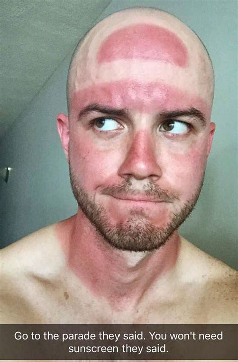 “Always Wear Sunscreen!”: 40 People Who Failed To Do It And Ended Up ...