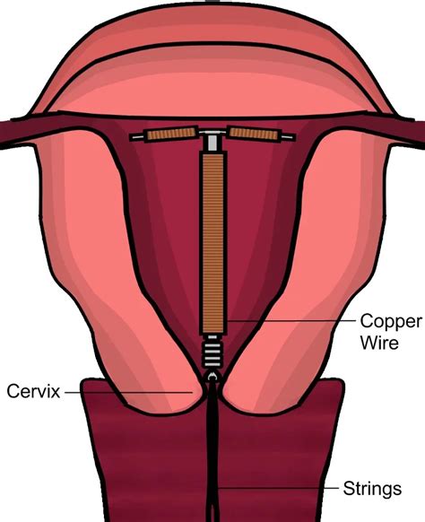 High Efficiency Device Long-acting Reversible Contraception ...