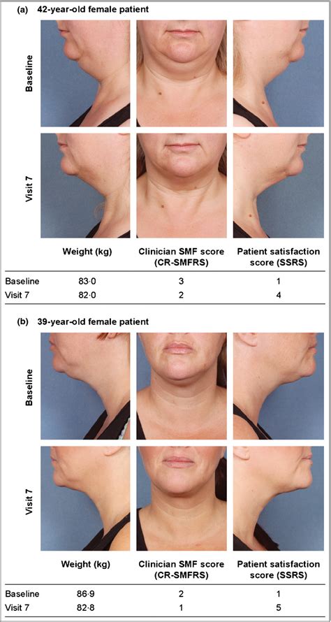 Reduction of unwanted submental fat with ATX‐101 (deoxycholic acid), an adipocytolytic ...