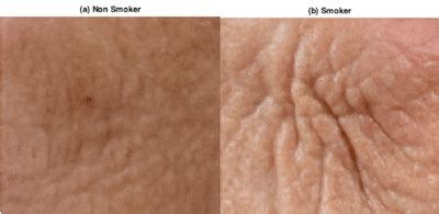 The effect of smoking on face skin: (a) illustrates the skin from a... | Download Scientific Diagram