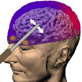 What is lobotomy? - Luria Neuroscience Institute