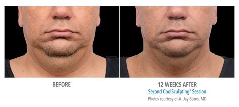 Double Chin Reduction Atlanta- CoolSculpting Chin - Sculpted Contours