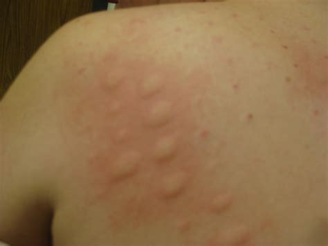 I get skin rashes whenever I'm sick. Should I be worried? : r/AskDocs