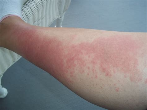 Red Spots On Skin Not Itchy 17 Causes Treatments Home - vrogue.co
