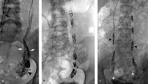 10 Pelvic and Gonadal Venous Reflux | Radiology Key