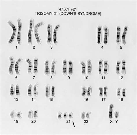 Down syndrome human karyotype 47,XY,+21 | Wellcome Collection