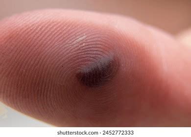 497 Blood Blister Finger Royalty-Free Images, Stock Photos & Pictures ...