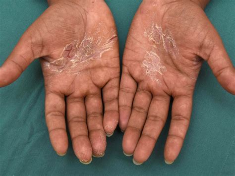 Cureus Dyshidrotic Eczema: A Common Cause Of Palmar, 42% OFF