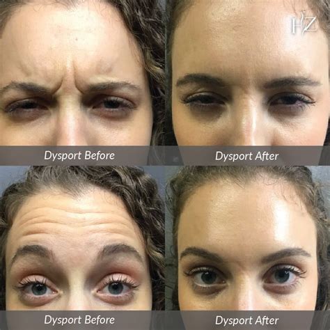 Yaaaas, 20 free units of #Dysport has never looked so good 😍Our beautiful patient targeted her ...