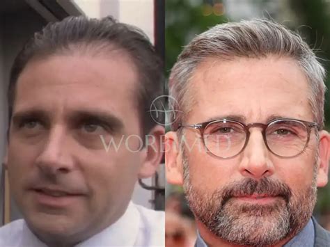 Steve Carell Hair Transplant l Before and After