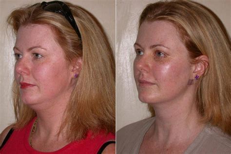 Facial-Plastic-Surgery9 - Liposuction before and after | Liposuction, Arm liposuction, Neck ...