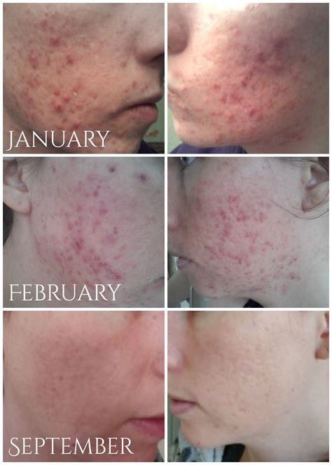 31+ Microneedling For Acne Scars Before And After Pictures Images ...