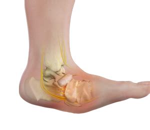 Charcot Foot Deformity Plano TX | Charcot Arthropathy Dallas, Garland TX