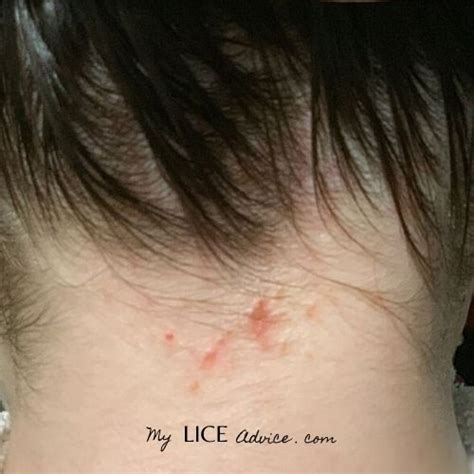 Images Of Lice Bites On Scalp : The more time you spend with. - Gezegen ...