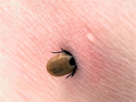 Tick-borne diseases are back. Here's the best way to check for tick bites this summer.