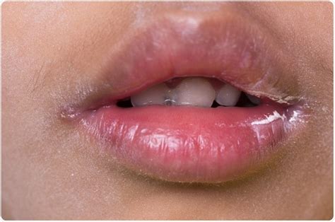 Angular Cheilitis Causes and Treatments - Bhaskar Health: trustworthy ...