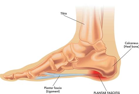 Heel Pain in the Morning: What Conditions cause Heel Pain