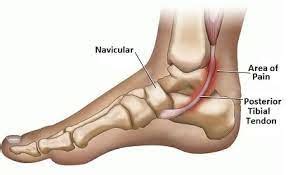 Posterior Tibialis Tendon Dysfunction (PTTD) – Acquired Adult Flat Foot