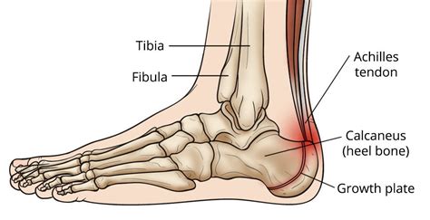 Sever's Disease (Heel Pain) - OrthoInfo - AAOS