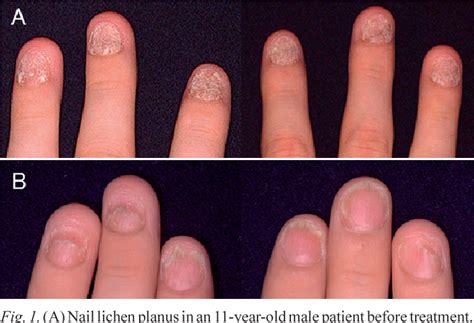 lichen planus of nail | Semantic Scholar