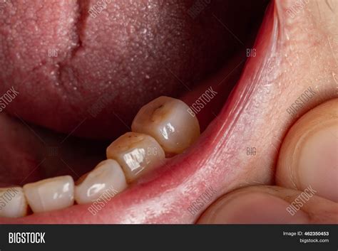 Crowned Teeth. Image & Photo (Free Trial) | Bigstock