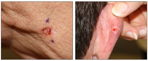 Ulcerated Basal Cell Carcinoma - Dr Monica Scheel Dermatology