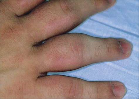 Finger Joint Pain After Injury at Jerry Houston blog