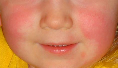 What is Scarlet Fever - Symptoms & Treatment - Mother Distracted