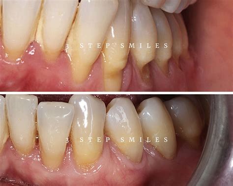 Gum Tissue Graft Surgery - procedure, causes, techniques and more