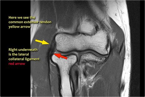 MRI Protocols: ELBOW MRI ANATOMY