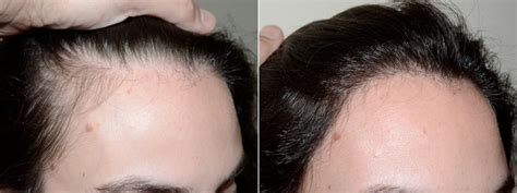 Hair Transplants for Women photos | Miami, FL | Patient71499