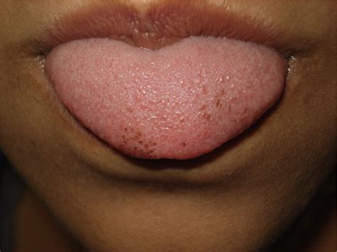 Dermoscopy of pigmented fungiform papillae of the tongue - Journal of the American Academy of ...