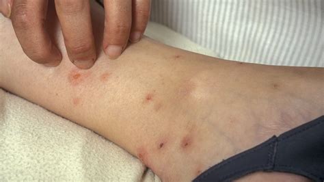Pictures Of Healing Bed Bug Bites - PestPhobia