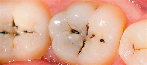 Are Cavities Reversible?
