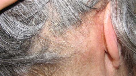 Seborrheic Dermatitis Scalp