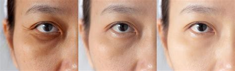 Is Botox Under the Eyes Safe? What to Know Before Treatment