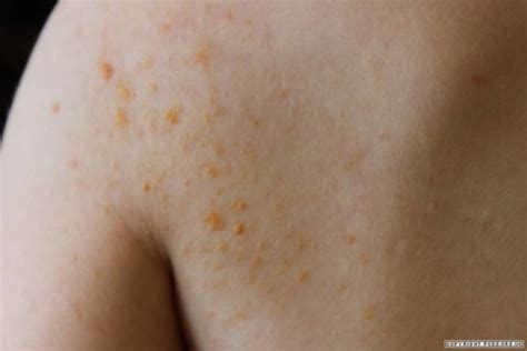 Warning Signs Of Eruptive Xanthomatosis A Skin Condition