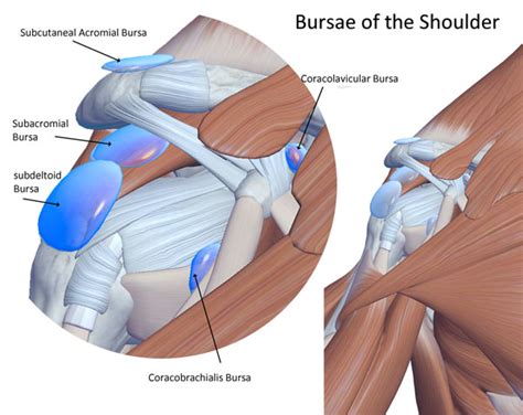 Subdeltoid Bursitis Ultrasound