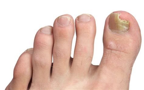 How to Identify and Address Your Toenail Problems - The Foot Doc™