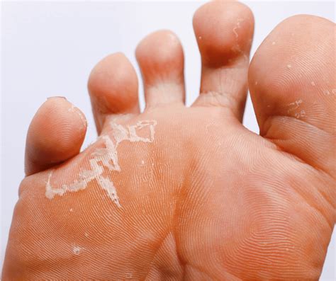 Expert Treatment for Toenail Fungus in North Seattle | Foot and Ankle Center of Lake City