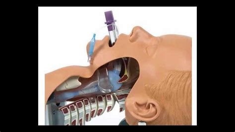 Airway Devices 04: Blind / Supraglottic - YouTube