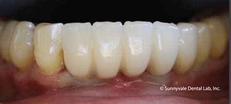 Implant Supported Bridge – Sunnyvale Dental Lab & Milling Center