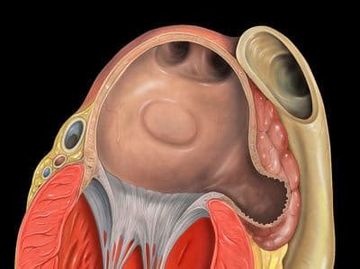 Reducing Stroke Risk - Clip The Left Atrial Appendage