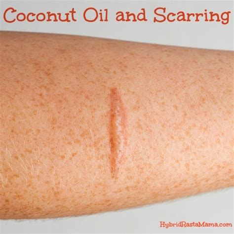 Coconut Oil and Scarring (Plus a Few Other Natural Remedies) by Hybrid Rasta Mama