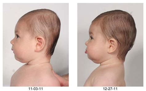 The Baby With A Flat Head: How To Reverse The Rising Tide Of Plagiocephaly