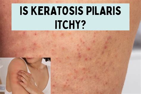 Does Keratosis Pilaris Itch?