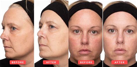 Exponent Beauty Vitamin C Serum Before and After Images | Exponent