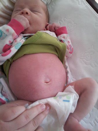 bloated belly *pic* - BabyCenter