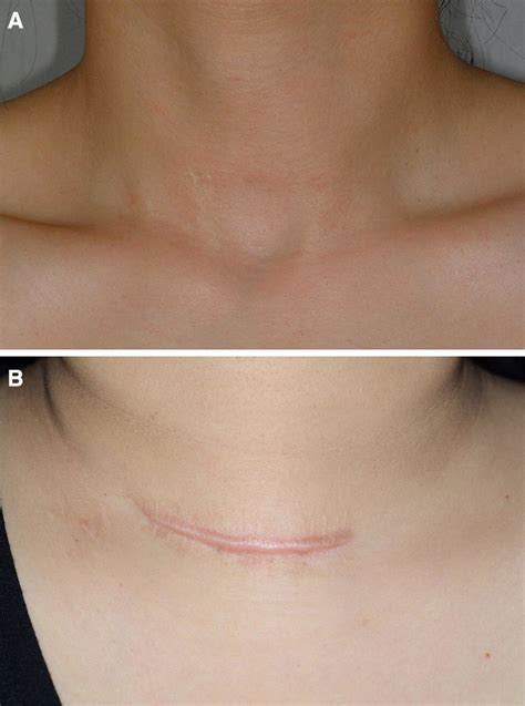 Scar Tissue After Thyroid Surgery