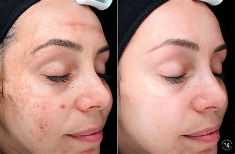 Chemical Peels Photos | Houston, Tx | Patient 10795